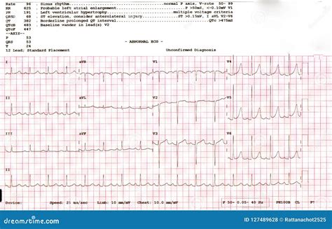 ekg test is hard|abnormal ekg for heart patients.